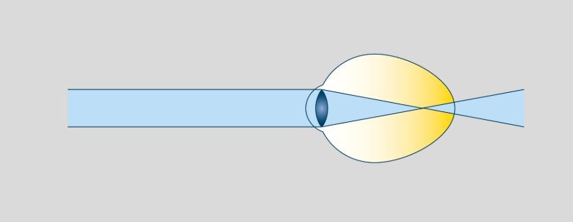 Kurzsichtig_Schema