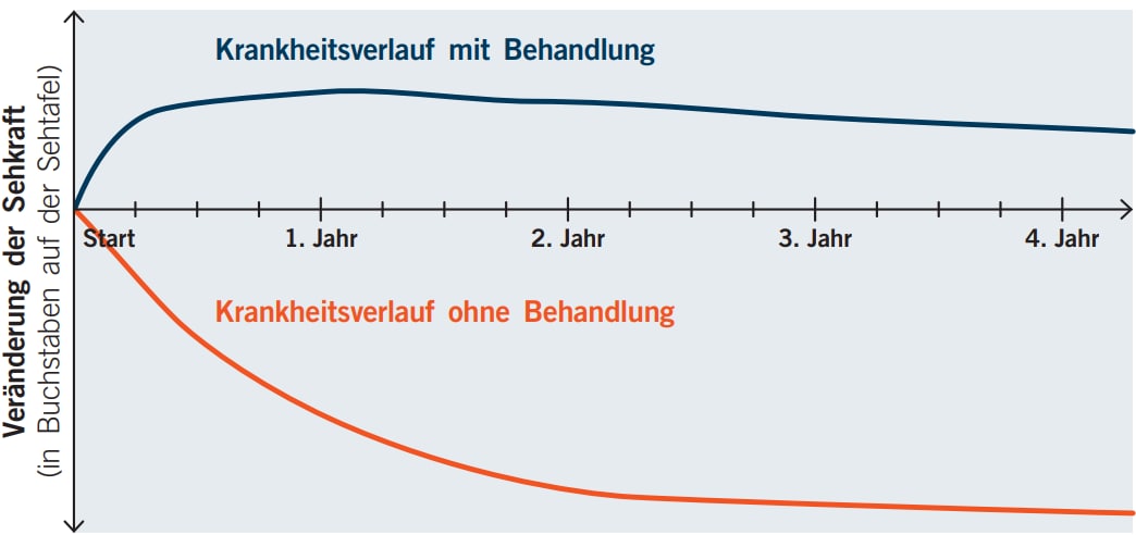 Grafik, die zeigt, wie sich eine feuchte AMD mit und ohne Behandlung entwickelt