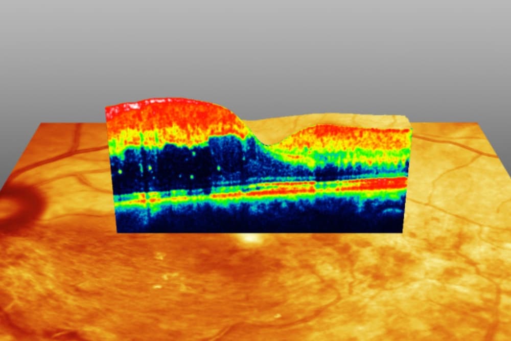 OCT-Scan retinaler Venenastverschluss (VAV) 1000x667px